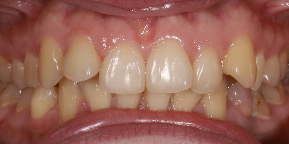 Лечение на металлической брекет-системе