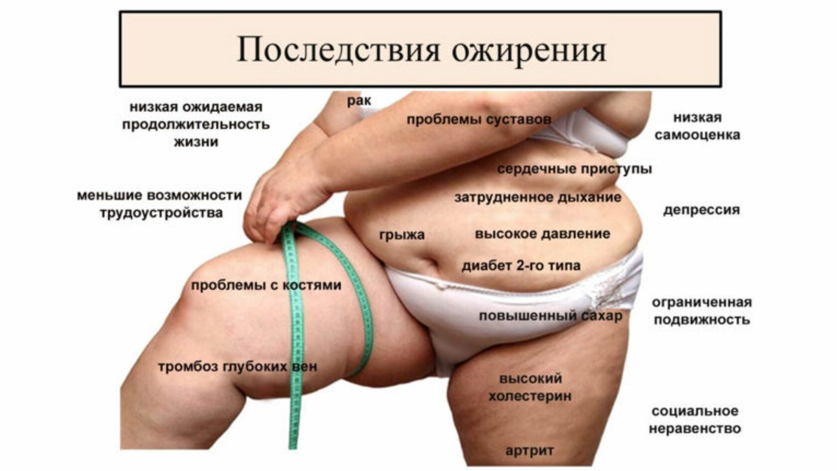 Можно ли похудеть при морбидном ожирении без спорта Можно ли похудеть при морбидном ожирении без спорта