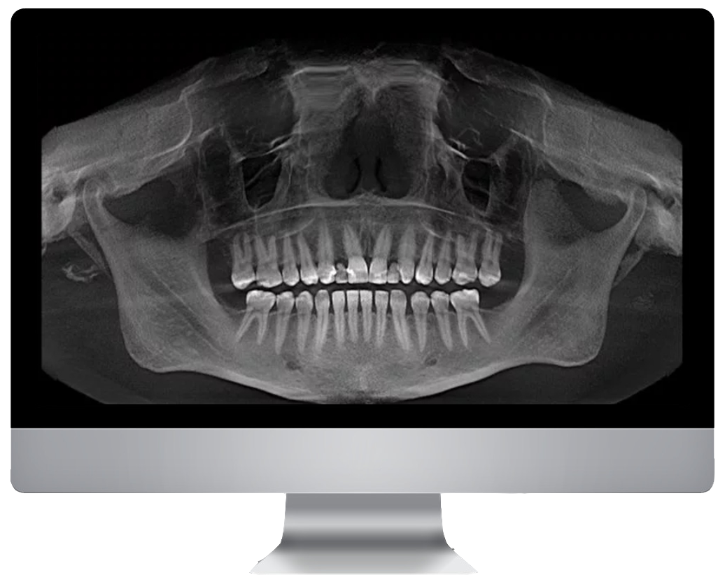 Снимок без. Ортопантомограмма панорамный снимок челюсти. Ортопантомограмма (ОПГ).