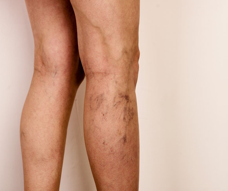 Вены станут заметнее