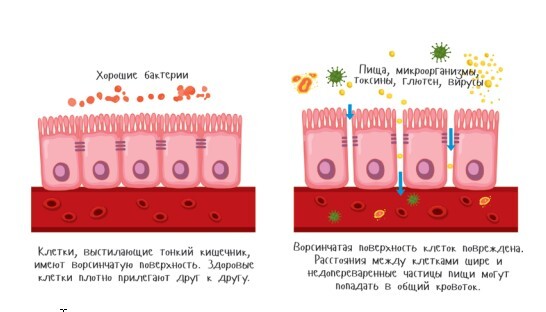 Синдром повышенной проницаемости кишечника