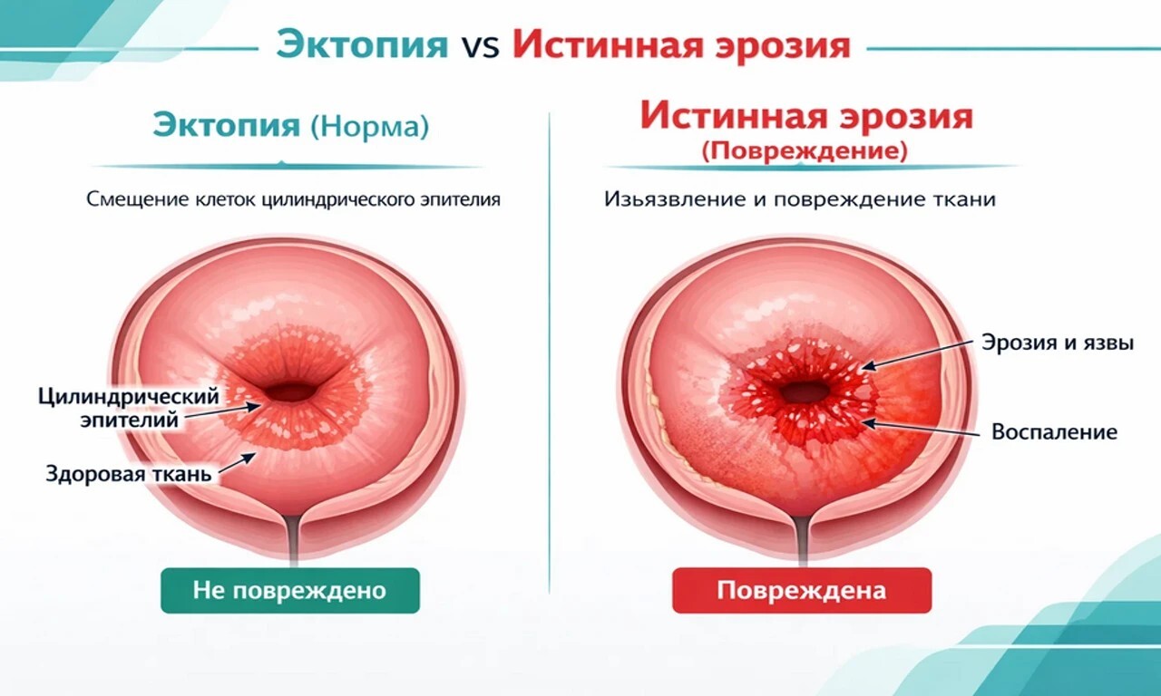 Виды эрозии шейки матки инфографика.
