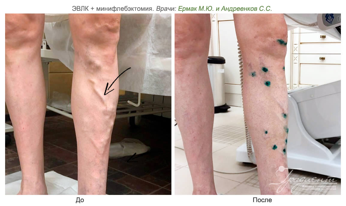 Лечение варикоза лазером в клинике инновационных медицинских технологий  «Градиент» в Москве