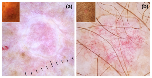 Порокератоз: дерматоскопические признаки