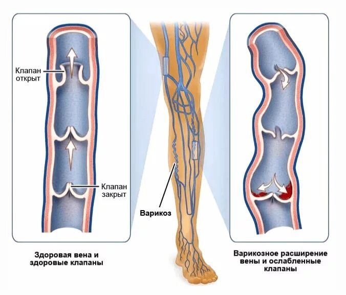 Тромбоз студфайл. Тромбофлебит подкожных вен. Варикозная болезнь нижних конечностей с3. Варикозное расширение вен (ВРВ) нижних конечностей.