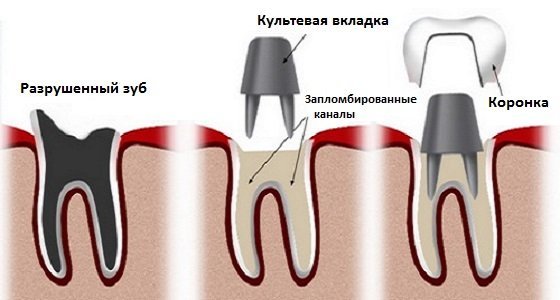 Наращивание зуба на штифт – зуб как новенький