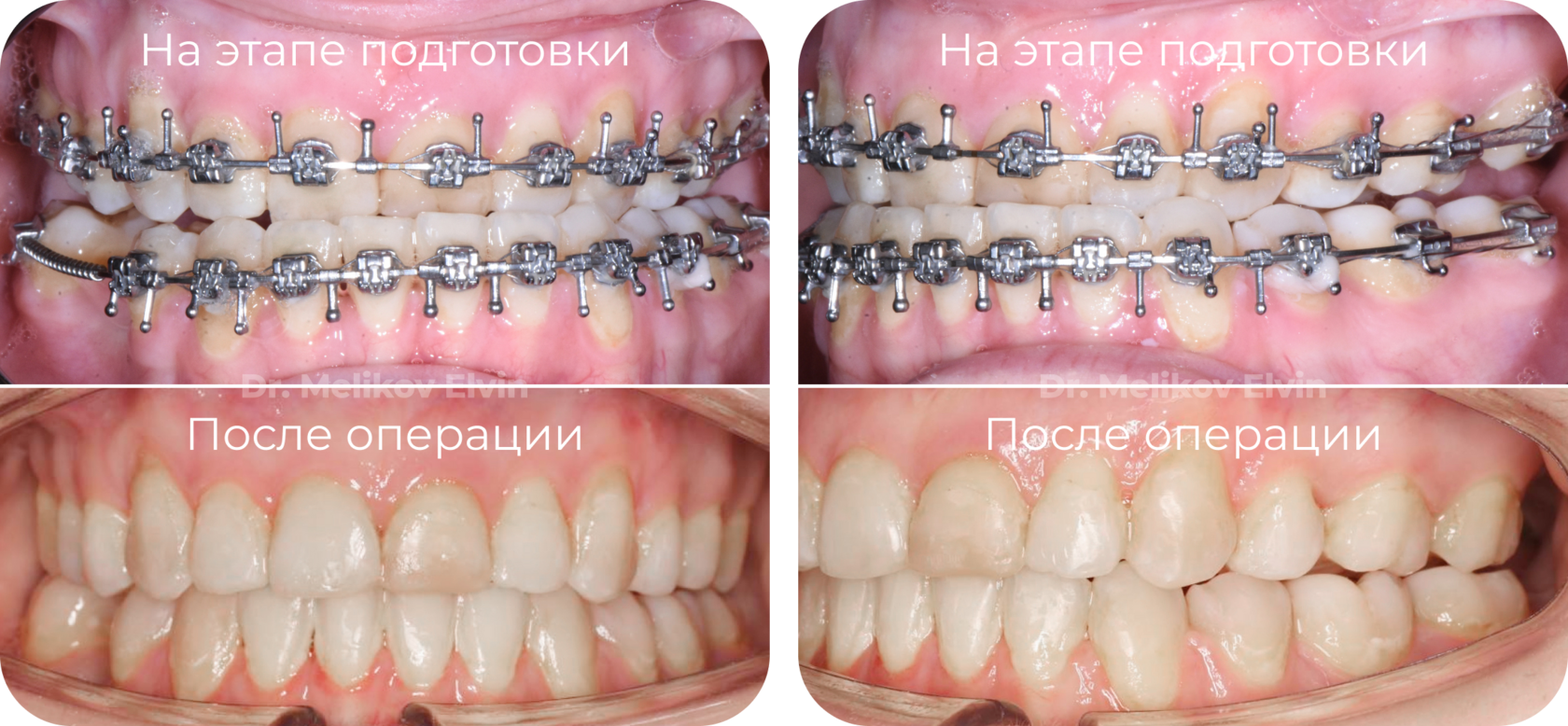 Фотографии прикуса до и после ортогнатической операции.