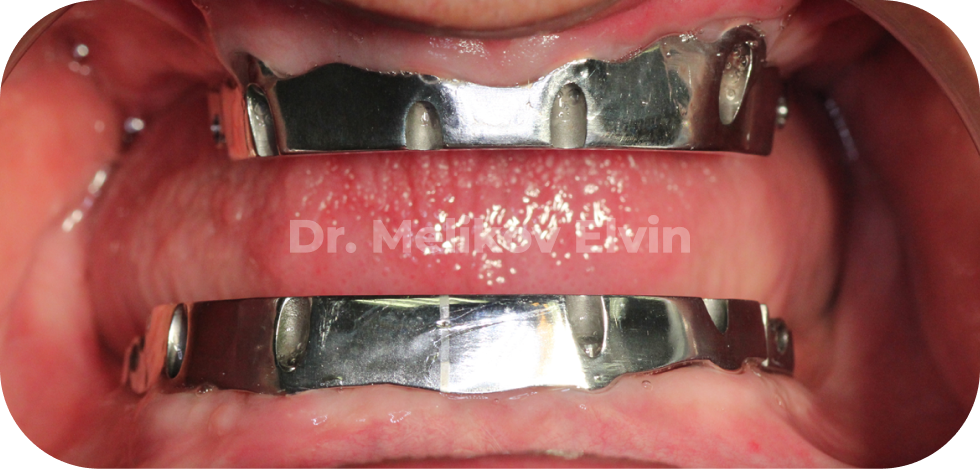 Имплантация зубов