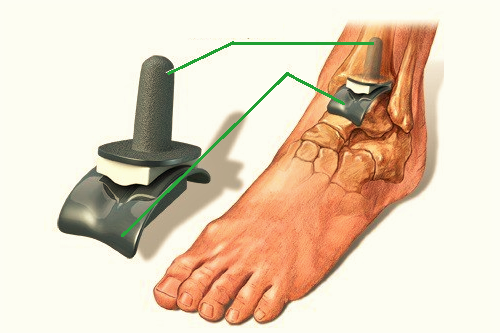 Замена ноги. Остеоартроз голеностопного сустава. Эндопротез голеностопного сустава. Артроз голеностопного сустава операции. Доа голеностопного сустава.