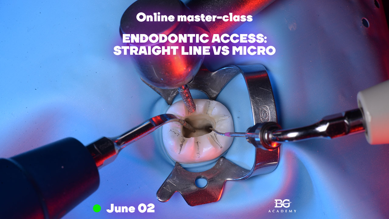 Endodontic access straight line VS micro. Stepbystep guide