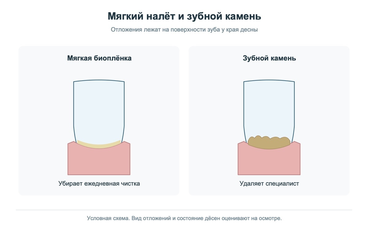 Отличия мягкого зубного налёта и зубного камня
