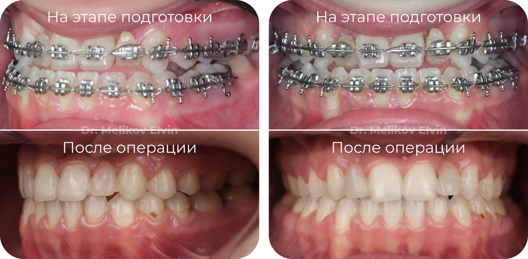 Фотографии прикуса до и после ортогнатической операции.