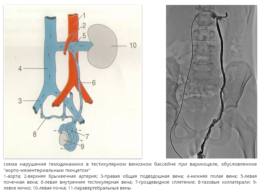 Детский варикоцеле