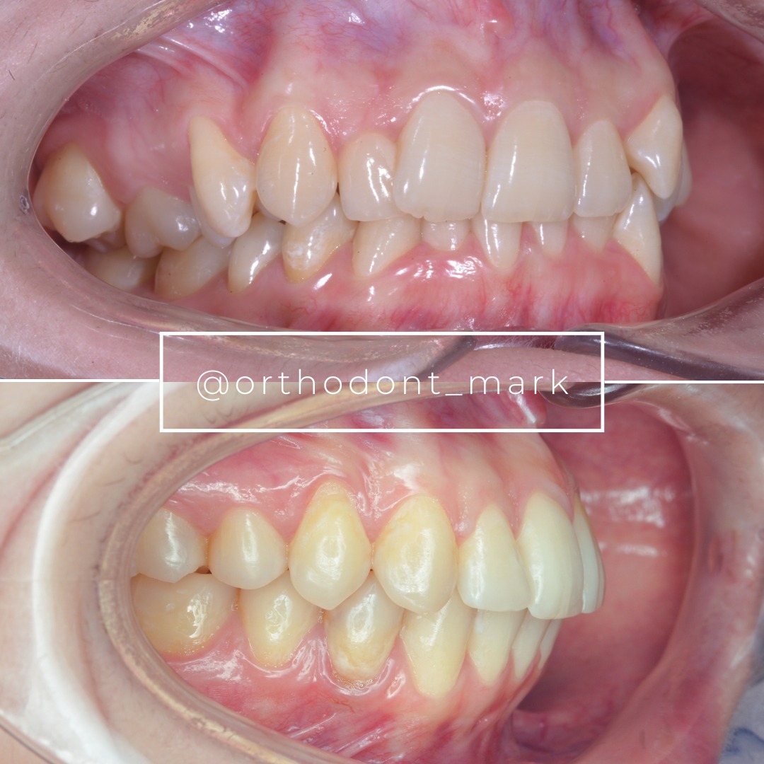 Stage showing continued crowding resolution without extraction — photo 3 of 6