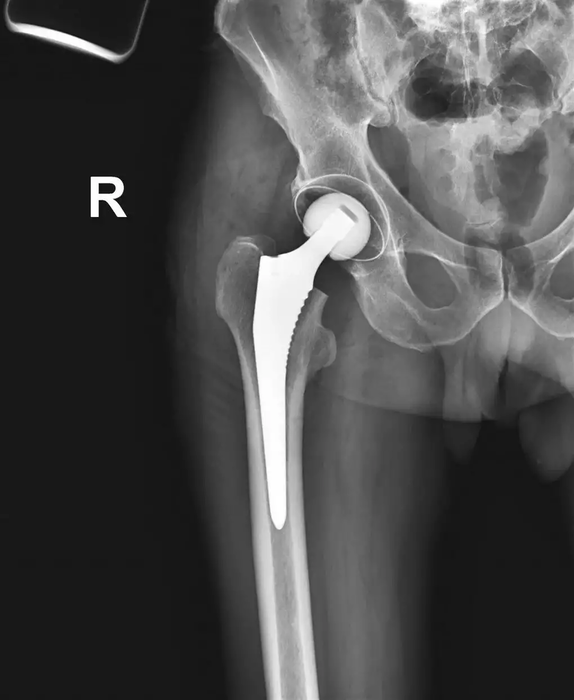 Коксартроз москва. Тазобедренный эндопротез Зиммер. Протез тазобедренного сустава рентген. Эндопротез ТБС рентген. Операция эндопротез тазобедренный.