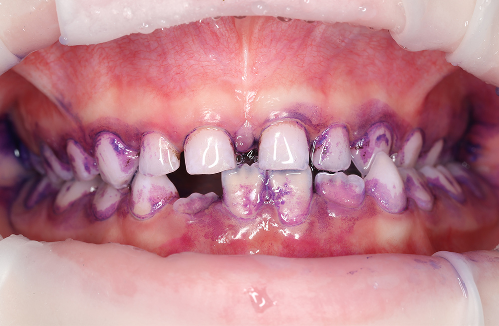 Первая профессиональная гигиена полости рта у ребёнка с использованием Air Flow