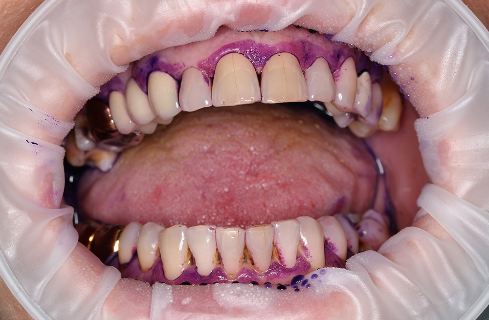 Процедура профессиональной гигиены полости рта на аппарате Air Flow