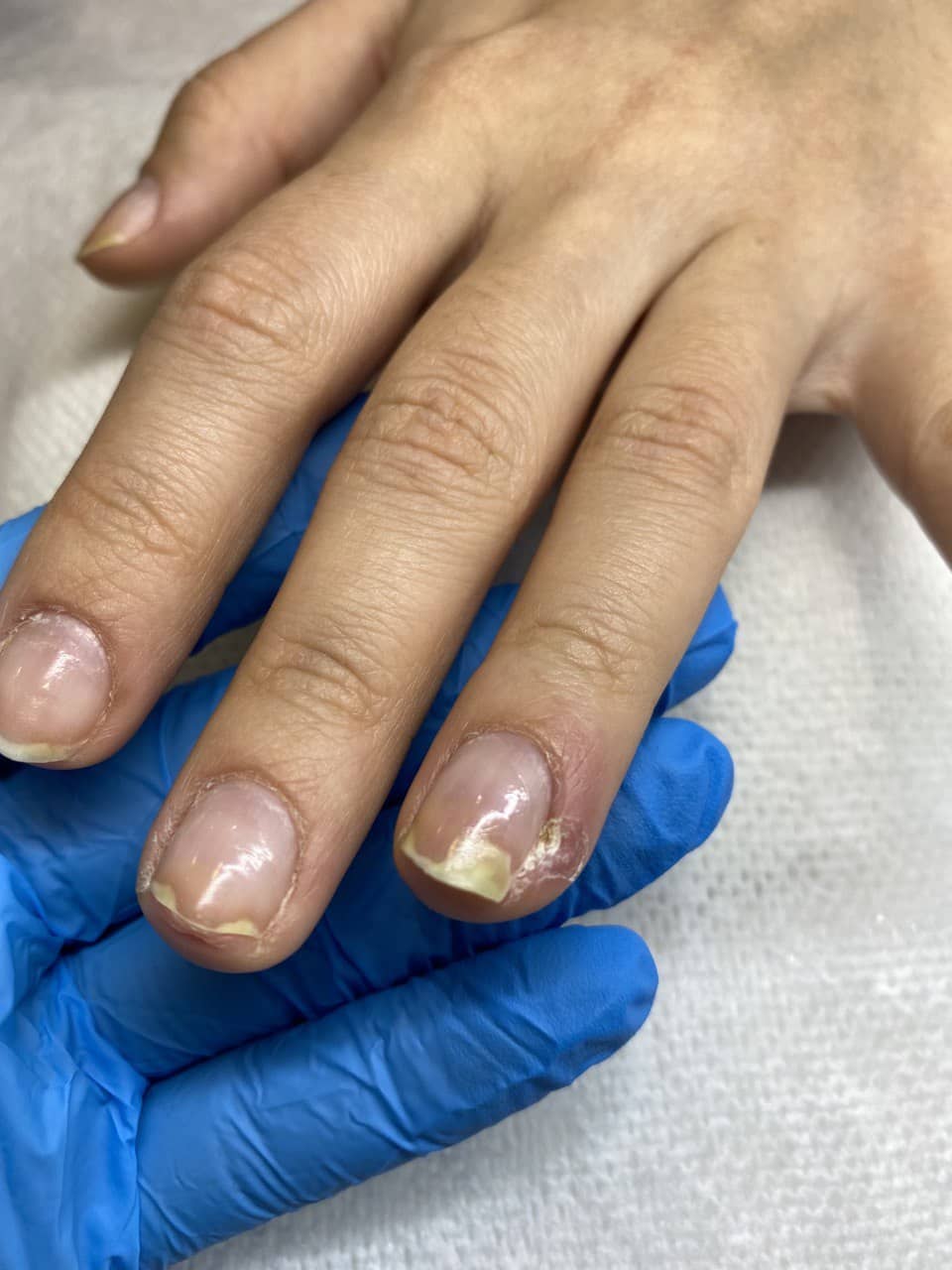 онихолизис купить