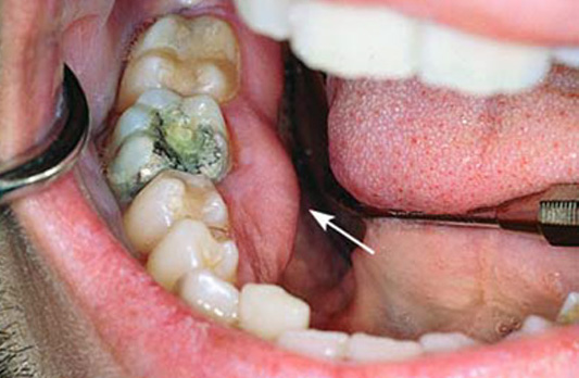Основные симптомы стоматологических заболеваний