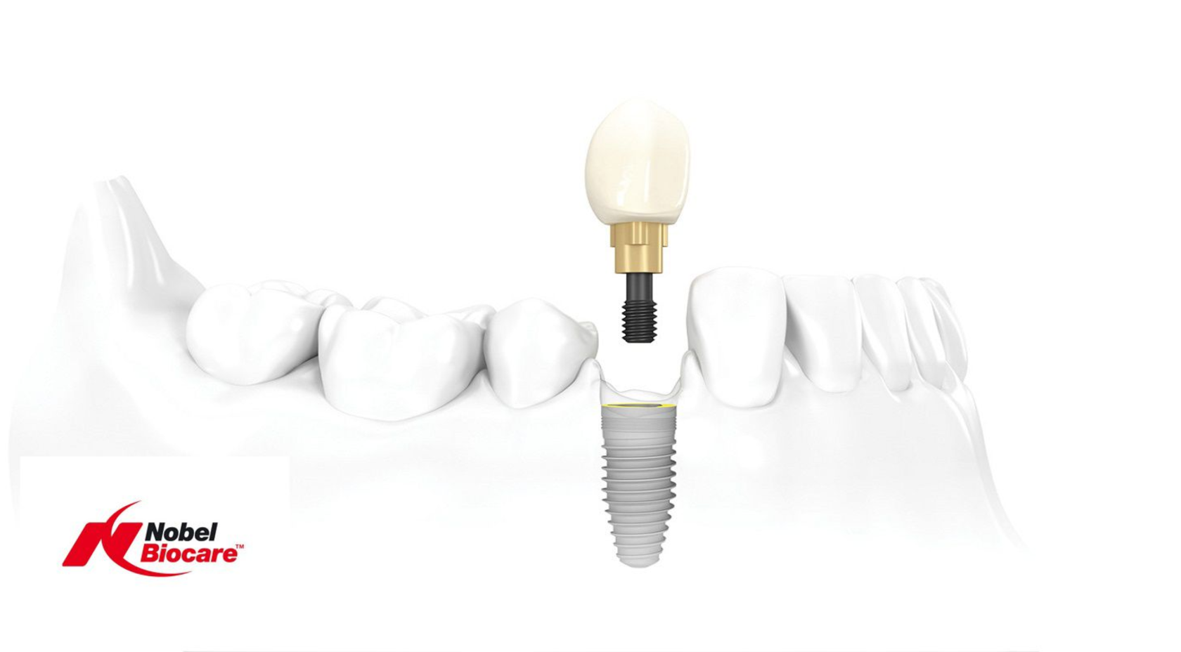 Имплантаты Nobel Biocare