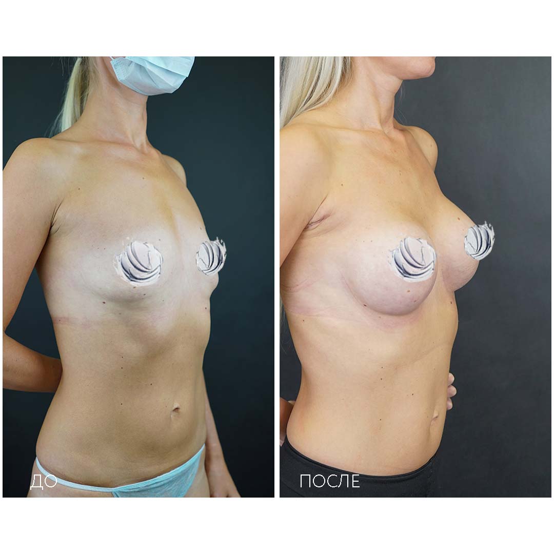 подтяжка груди у женщин фото 34