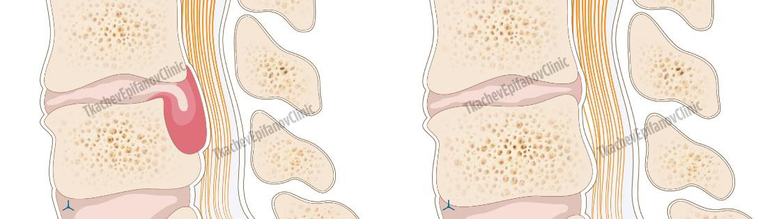 Herniated disc - Symptoms, Causes and Treatments