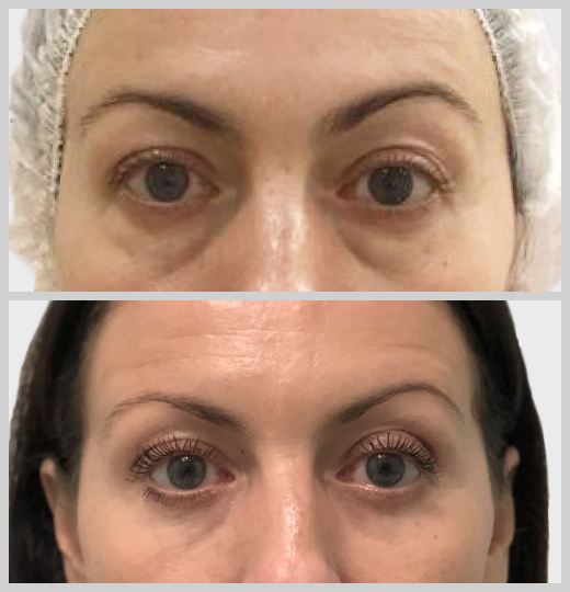 блефаропластика нависшие веки