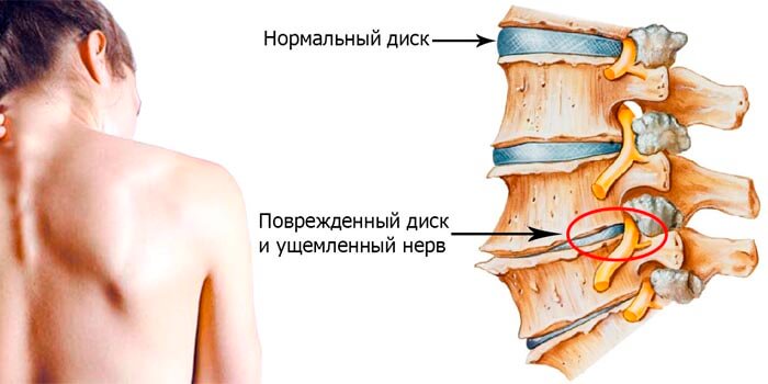 остеохондроз, позвоночник, межпозвоночный диск, боль