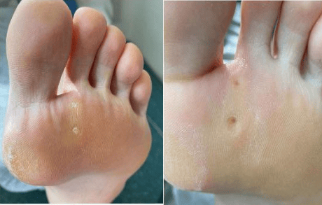 Мозоли между пальцев