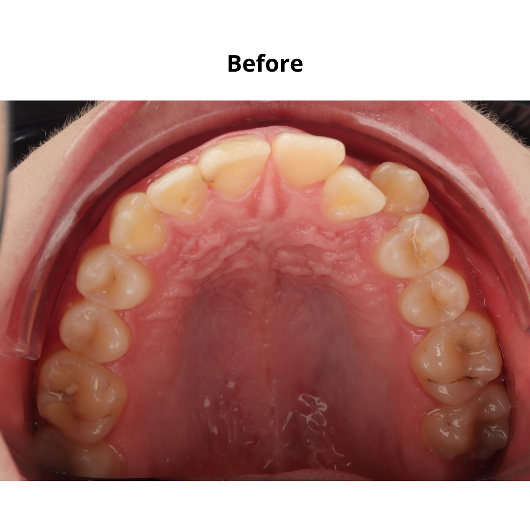 Stage showing the canine erupted into the oral cavity during treatment — photo 3 of 7