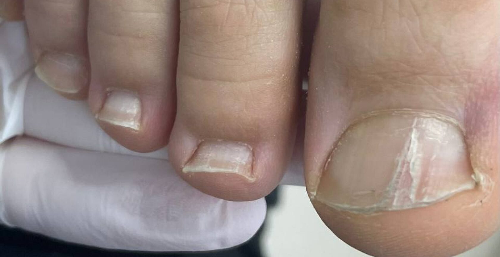 Ониходистрофия (дистрофия ногтей) - причины и лечение