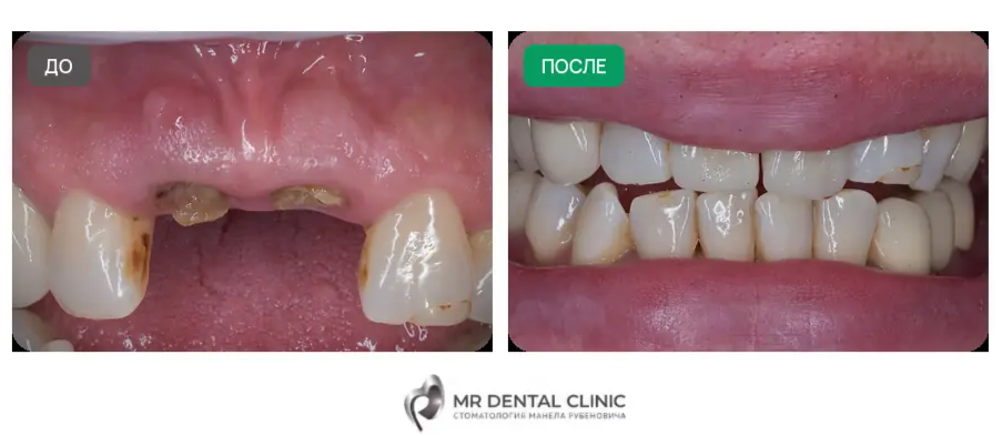 Имплантация двух передних зубов Medentika: фотографии до и после лечения в MR Dental Clinic