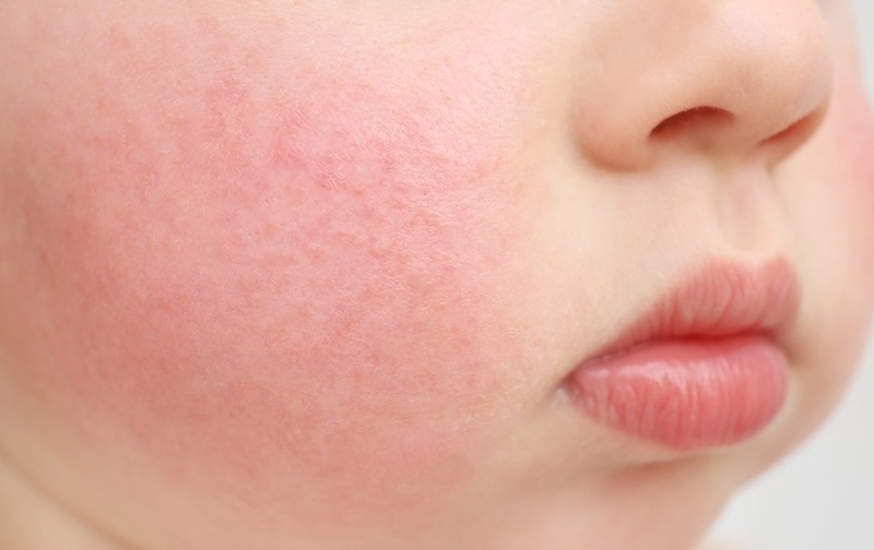 Инфекционная эритема - парвовирус