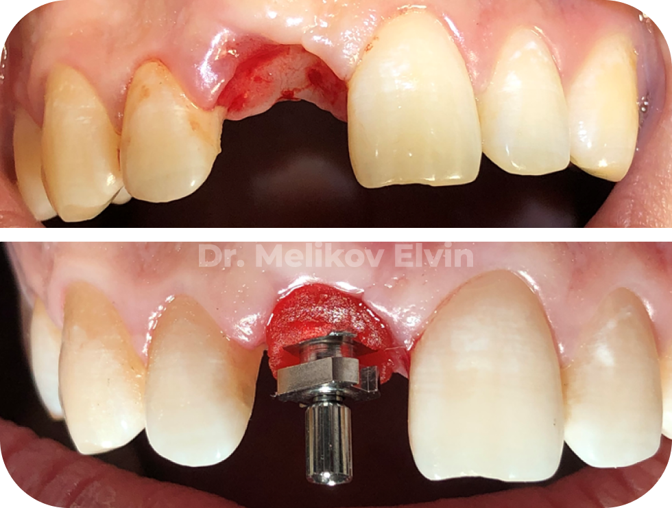 Снятие оттиска трансфером для открытой ложки
