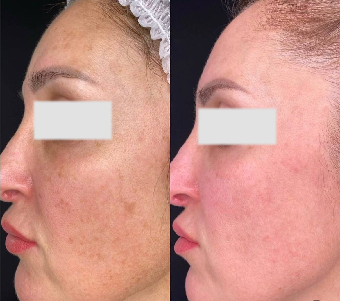 Результат до и после комплексного протокола Healthy Glow