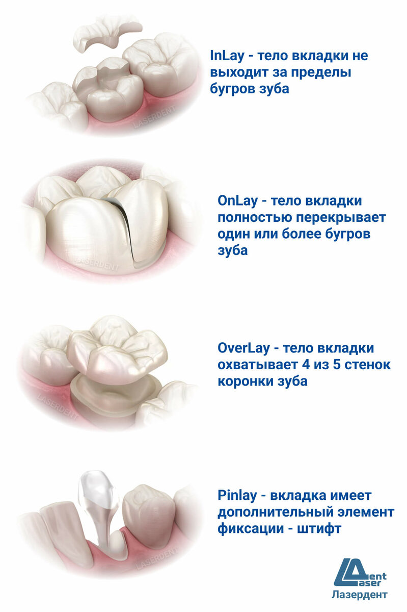 Протезирование Зубными Вкладками Лазердент Хабаровск. Цена, Адрес, Телефон
