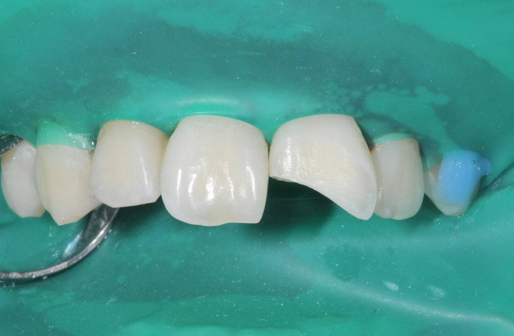 Восстановление сколотого края центрального резца композитомпри травматическом переломе коронки