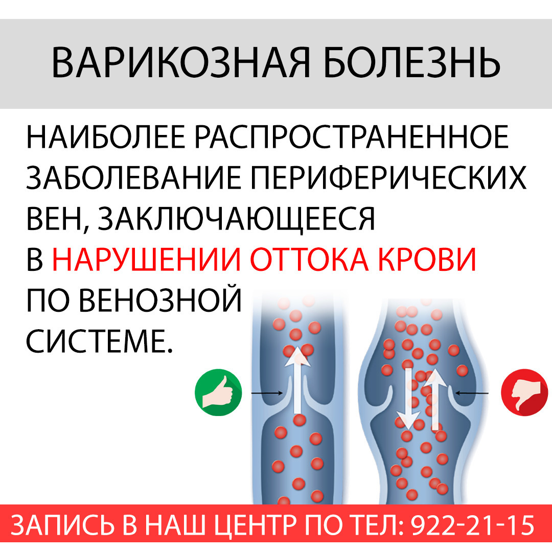 Варикозное расширение вен нижних конечностей карта вызова скорой медицинской