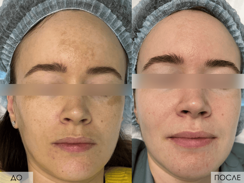 Сочетание мезотерапии и биоревитализации для осветления кожи от Мезофарм