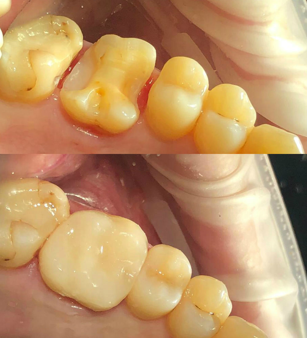 реставрация зубов результат