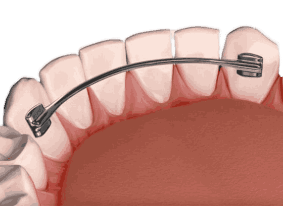 Протезы передних зубов в стоматологии Барышева ☎ +7 (908) 237-73-77 