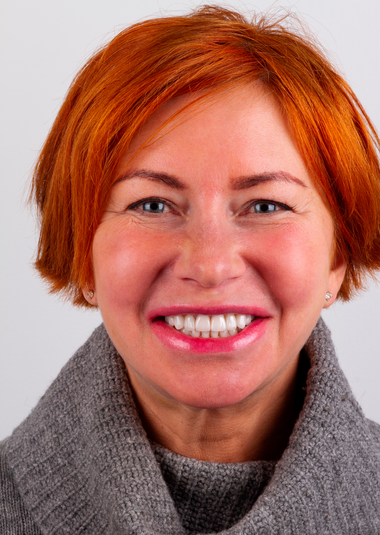 Виниры для зубов цена в Санкт-Петербурге установка в стоматологии СториДент