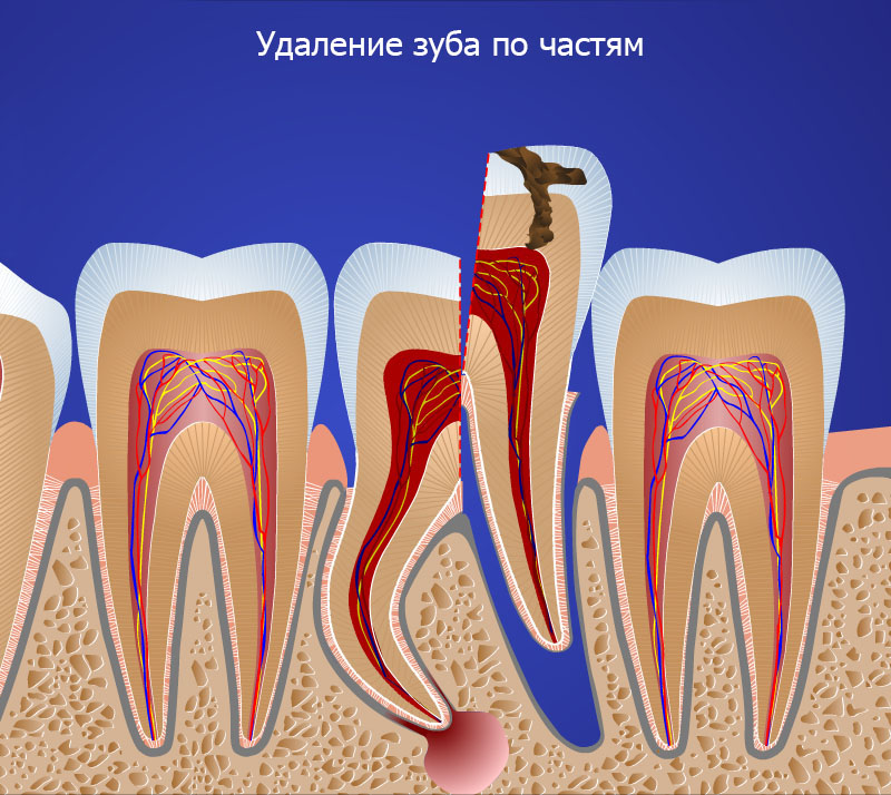 Картинки прикольные удаление зуба