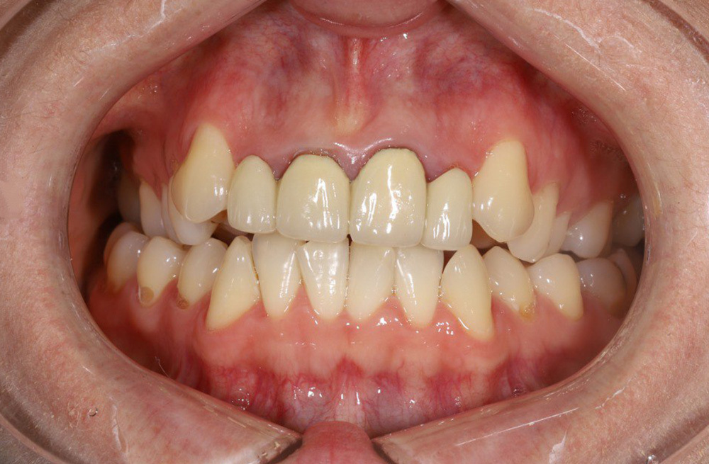 Замена устаревших металлокерамических коронок на циркониевые для улучшения внешнего вида и функции