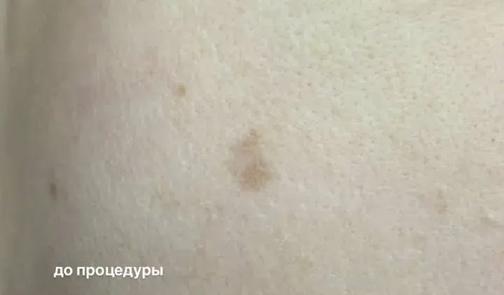 Пигментное пятно на коже, до