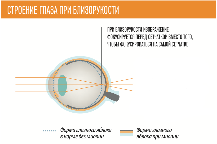 Очковая линза miyosmart. При миопии изображение фокусируется. Перед сетчаткой. У близоруких изображение фокусируется за сетчаткой. Схема формирования изображения в близоруком глазу.