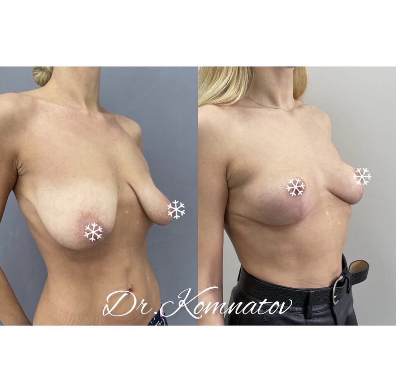 асимметрия груди у женщин форум фото 33