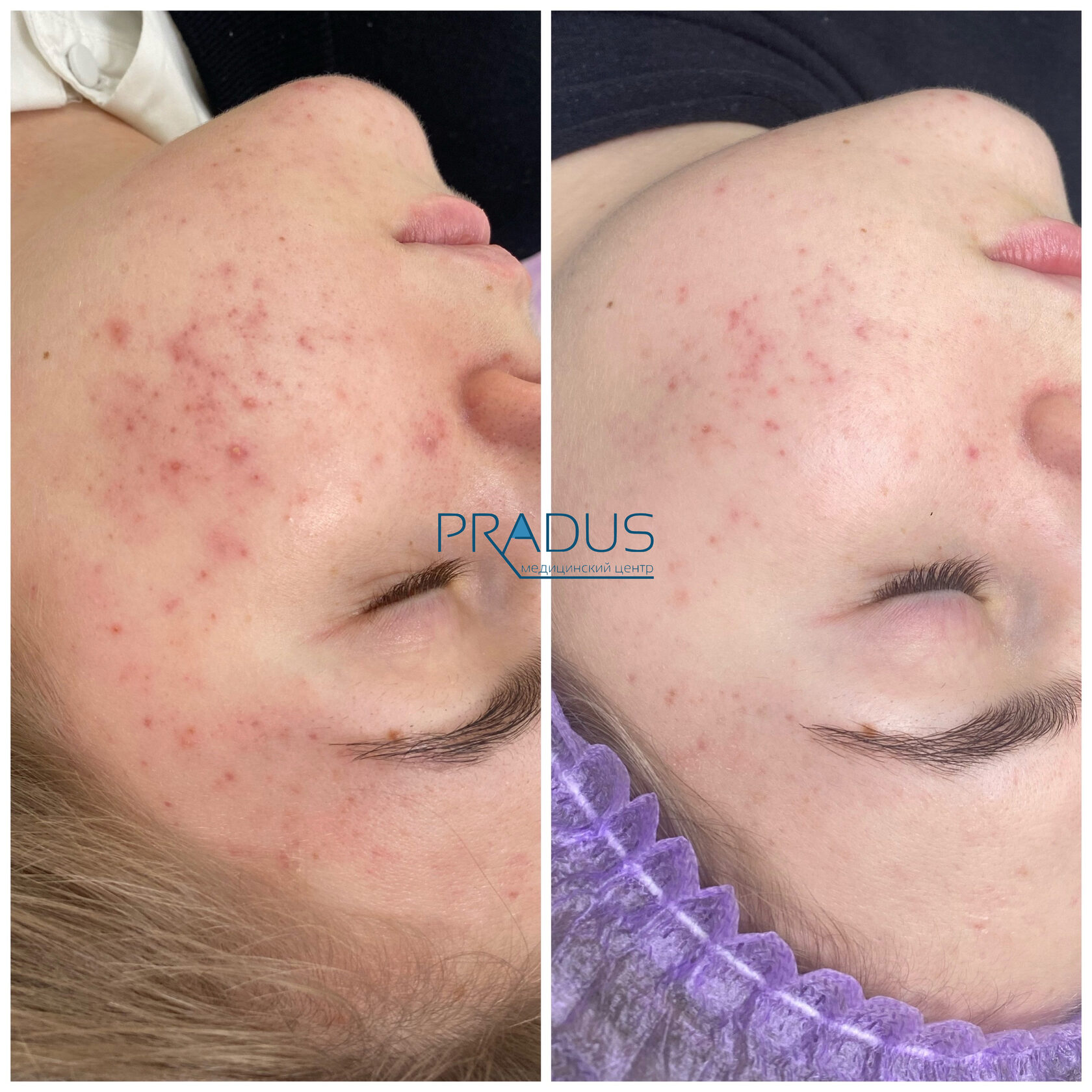 Лечение акне у женщины в клинике PradusCOSMO, СПб. До и после процедуры