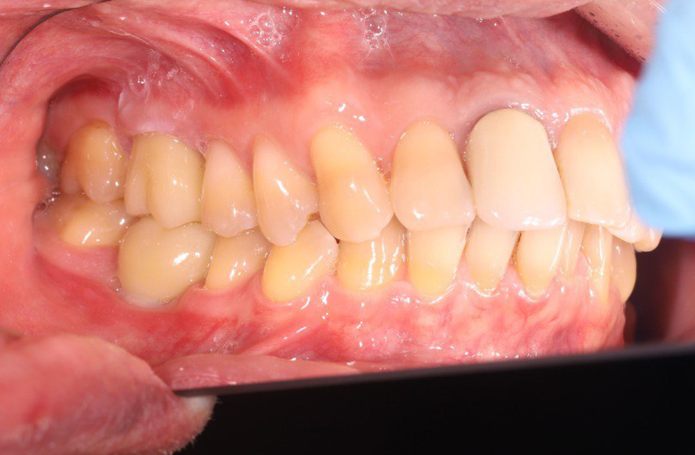 Установка циркониевых коронок в процессе имплантации зубов верхней и нижней челюсти