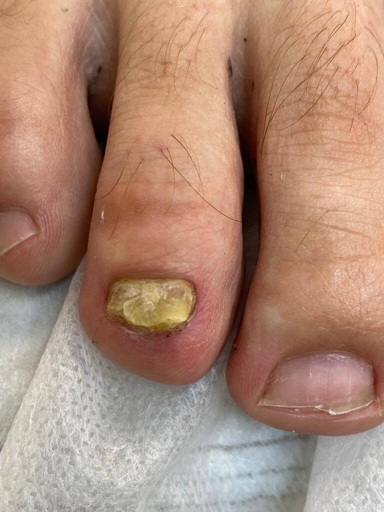 Грибок ногтей